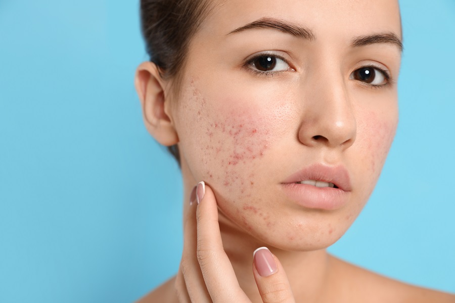 People with acne breakouts cannot undergo dermaplaning
