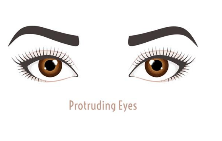 Protruding Eyes